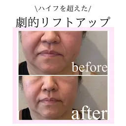 【通常価格40000円以上】💎たるみ・ほうれい線・小顔💎劇的リフトアップ打ち放題