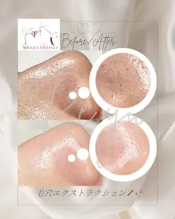 毛穴エクストラクション【練習モデル】【鼻のみ】