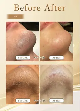 メンズヒゲ脱毛（ヒゲ全部+眉毛周り+小鼻）