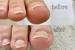 【オフ無し】両親指巻き爪矯正