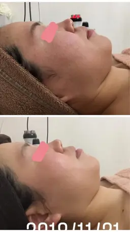 期間限定☆お得なクーポン//毛穴ケア+小顔エステコース//ハイパーナイフ&ハンドマッサージでしっかり結果出し!