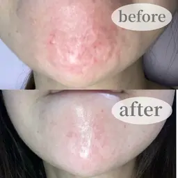【１日2名様限定】ニキビ悩みに!ゴワゴワ肌完全改善☆【毛穴掃除+生炭酸ニキビケアコース】