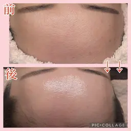 【ミニモREVIハーブピーリング】"ごわつきざらつき解消"通常価格¥11000→¥8800