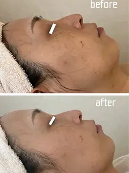 卒業式・入学式前 しみ・くすみ集中フェイシャル