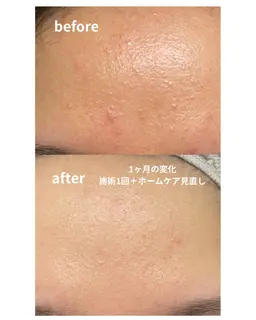 【ミニモ限定/フェイシャルモニター様募集】ニキビ・赤味・敏感肌の方向け/お悩み改善コース