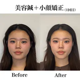 💎初回限定💎小顔矯正＋美容鍼付き✨