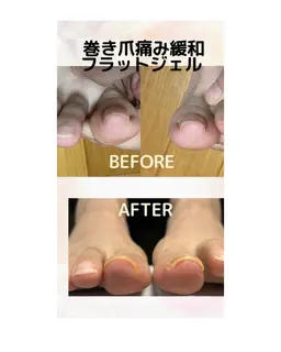 初回　巻き爪フラットジェル