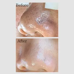 【Jr.スタッフ対応】美容液で行うハイドラ毛穴洗浄