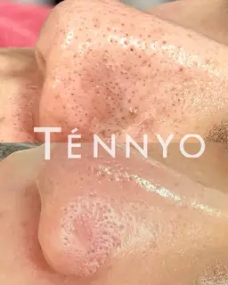 毛穴洗浄。温泉水ベースの専用美容液で優しく古い角質/角栓/皮脂などの汚れを取り除きます★化粧ノリも◎スキンケアの浸透も◎