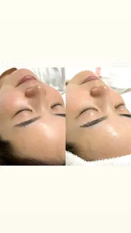 夏のキャンペーン✨(シェービング)