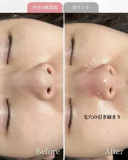 平日限定!NEWオープン特別《毛穴洗浄+毛穴吸引》気になる鼻の毛穴ごっそりとれる!ザラつき鼻さようなら🌈お試しクーポン