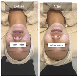 肌荒れ酷い方限定！ハーブピーリング🌿