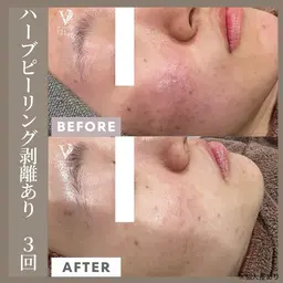 【ニキビ肌専用】ハーブピーリング剥離あり(2回目以降)/翌日メイクOK