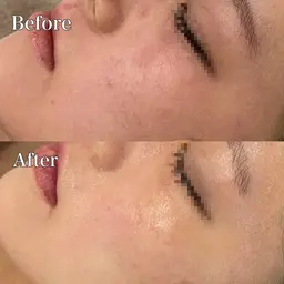 《大特価》ご新規様★乾燥/敏感肌/花粉/アレルギー等にお悩みの方に！乳酸ピーリング１回🥣小鼻毛穴洗浄込み✨️