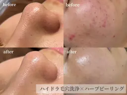 【1月限定✨】乾燥•ニキビ•毛穴・くすみ・敏感肌　乳酸菌ピーリング×毛穴洗浄（Tゾーン）