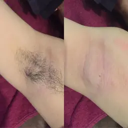 わき脱毛(ワックス＋光)