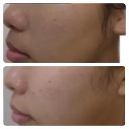 【くすみ撃退◎潤い美肌】肌診断+美白パック+リフトアップ+栄養導入　90分