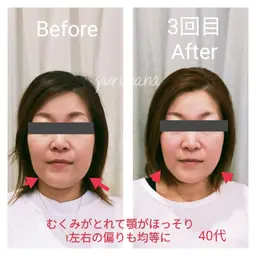 極上リフトアップ《人気No.1❤️リフトアップ／目ヂカラup／ほうれい線／ヘッドスパ》小顔矯正とヘッドコース（60分）