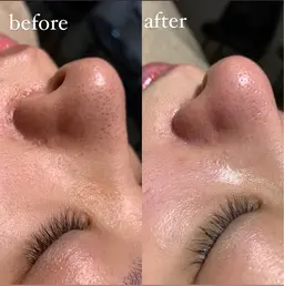 毛穴エクストラクション　¥8,800