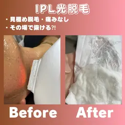 驚きの0円カウンセリング‼️追加料金無し。痛みのレベル確認に5回打ち★（お顔、腕、膝下のみ）