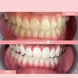 【初回から一気に白く♪】セルフホワイトニング照射15分×3回¥6980→¥2980［札幌/ホワイトニング/すすきの］