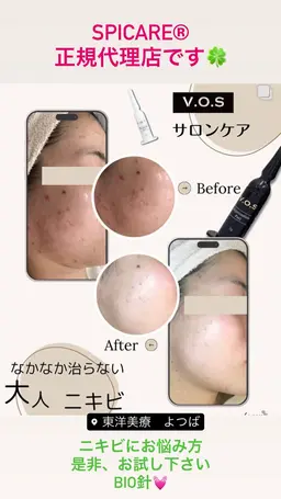 BIO針 美肌コースorニキビ肌コース