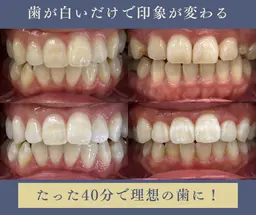 【ミニモ限定価格】ホワイトニング¥8800円→4600円🦷✨