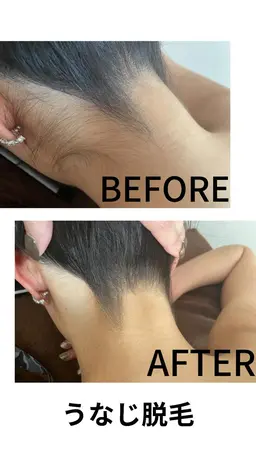 うなじ脱毛🩵