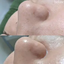 【💎毛穴引き締め最強ケア💎（顔脱毛＋ハイドロスキン）】最新THR美肌脱毛と毛穴洗浄でお悩みゼロ肌へ🧖‍♀️❣️