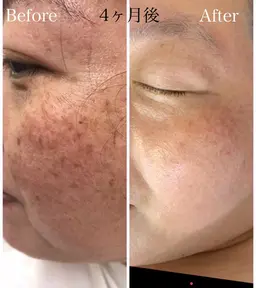 【－5歳肌】ヒト幹細胞 うる艶再生ケア 初回¥5,500