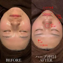 【好評につき期間延長💝】肌診断+ミクロ毛穴スペシャルケアコース🪄