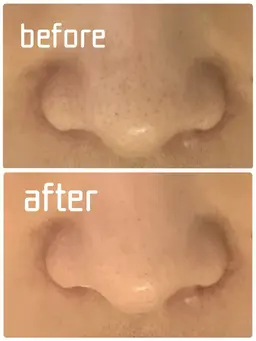 【先着10名】いちご鼻・黒ずみ毛穴ケア✨ソフトピーリングフェイシャル　40分　3980円