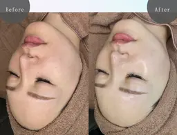 【韓国式】ララピール｜艶肌再生フェイシャル