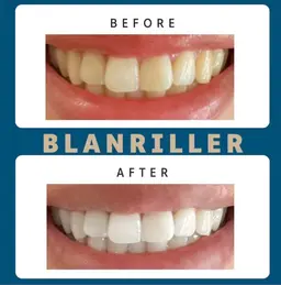 前回ご来店から1ヶ月以内のご予約で20%オフ❤️セルフホワイトニング15分×2回(30分照射)¥5000→¥4000🎶