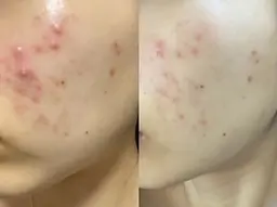 【大人気⭐︎】ハーブピーリング（痛み、剥離、DT無し&当日メイクOK）¥5000