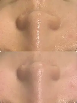 【毛穴の黒ずみ除去】毛穴洗浄×保湿潤パック