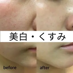 うる艶美肌【美白・くすみケア】剥けないハーブピーリング¥15,400→¥9,900(シルクパウダー)