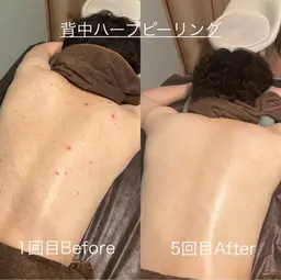 背中ハーブピーリング🌿ニキビ、ブライダル💒