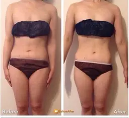 【2部位選択】キャビ&ラジオ波&リンパ70分￥16800→￥5500ダイエット！