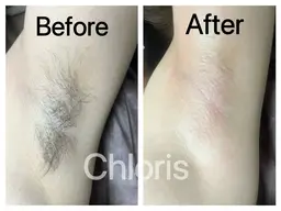 【初回限定】　【Wax脱毛】両わきケア