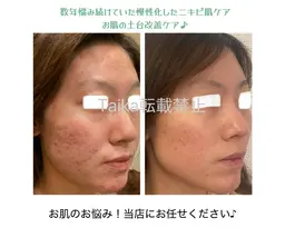 ニキビ肌ケア特化フェイシャル!モニター様募集※お写真可能な方(目元隠します)・SNS等の掲載可能な方・口コミを頂ける方