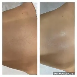 キッズ脱毛⭐️(7歳から13歳まで)1箇所¥1100