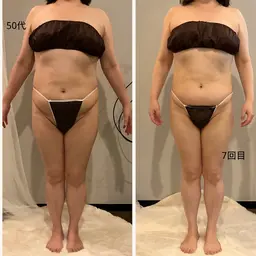 [お腹+二の腕+背中]ハイパーナイフEx+マッサージコース60分