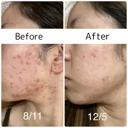 ミニモ限定特別価格🔥🔥【ニキビ撃退コース】