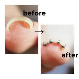 新規限定★巻き爪矯正 1本