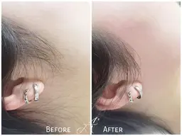 顔シュガーリング🍋脱毛