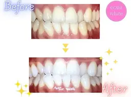 【minimo掲載記念✨️】セルフホワイトニング【9分✕2回】¥390別途料金なし