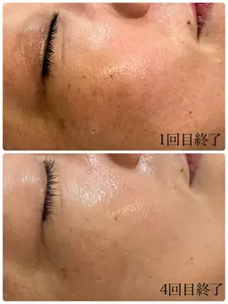 バクテリウムピール(ピーリング)