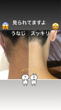 うなじ　ワックス＋光脱毛