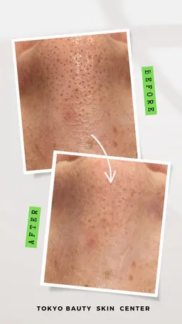 ☆当店人気No.1コース☆ハイドラ毛穴洗浄＆顔脱毛& PDRN美白液導入！毛穴汚れムダ毛ちゅるん！キメの整った美肌に！